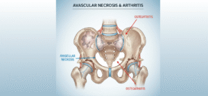 Avascular necrosis and arthritis causing hip and knee joint pain