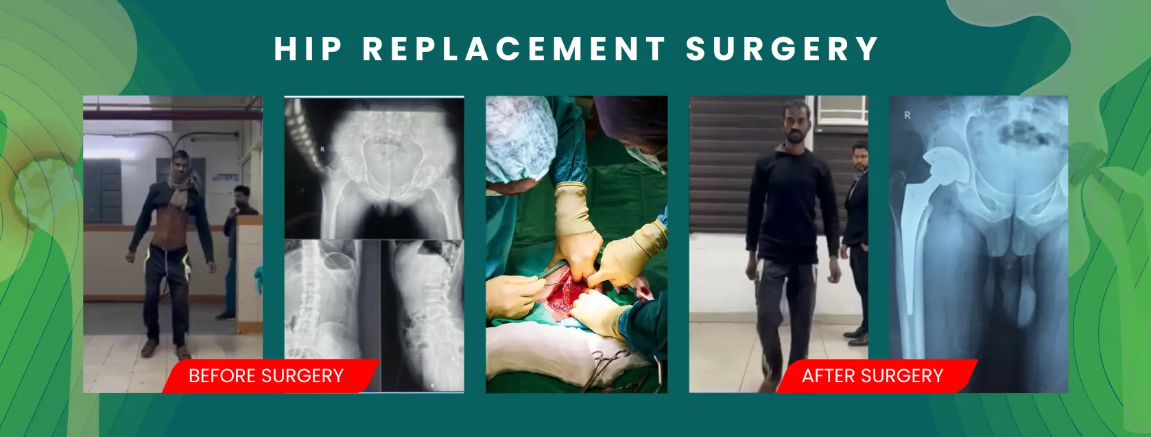 hip-replacement-surgery (1)