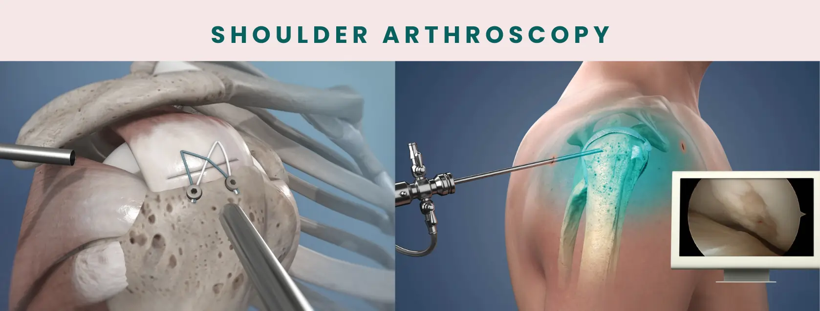 shoulder-arthroscopy