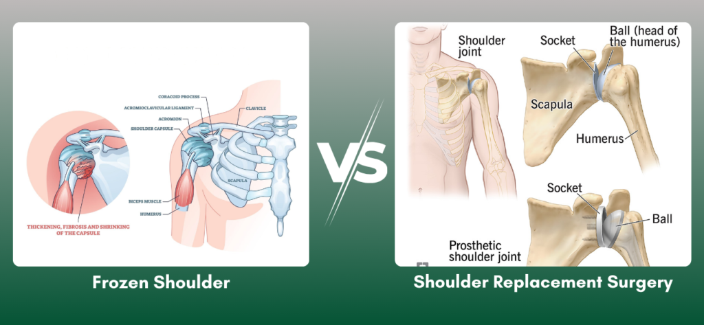 Frozen shoulder treatment vs shoulder replacement surgery showing shoulder joint pain and orthopedic treatment