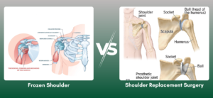Frozen shoulder treatment vs shoulder replacement surgery showing shoulder joint pain and orthopedic treatment